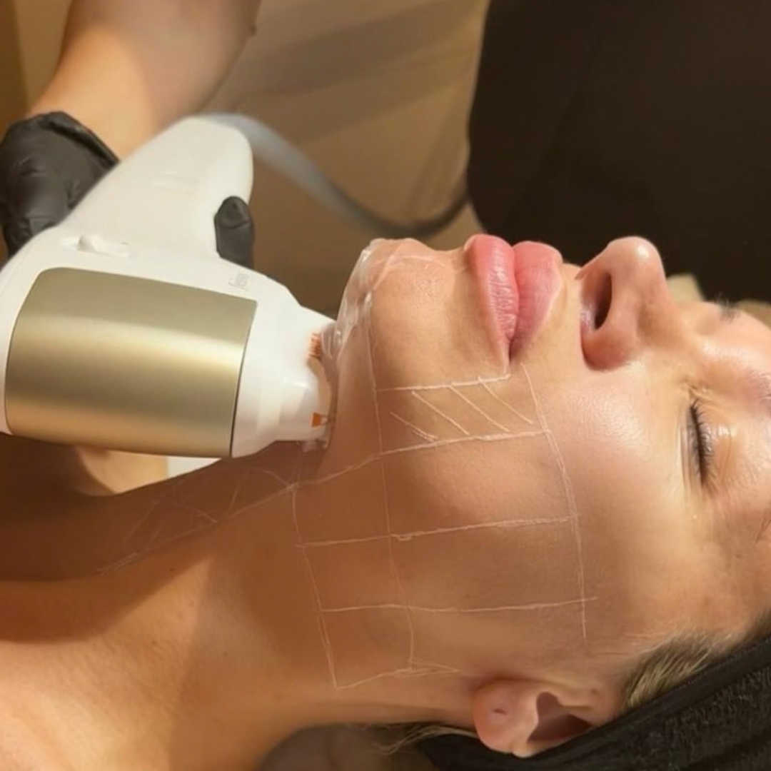 HIFU: tensa la piel y redefine el óvalo facial sin cirugía