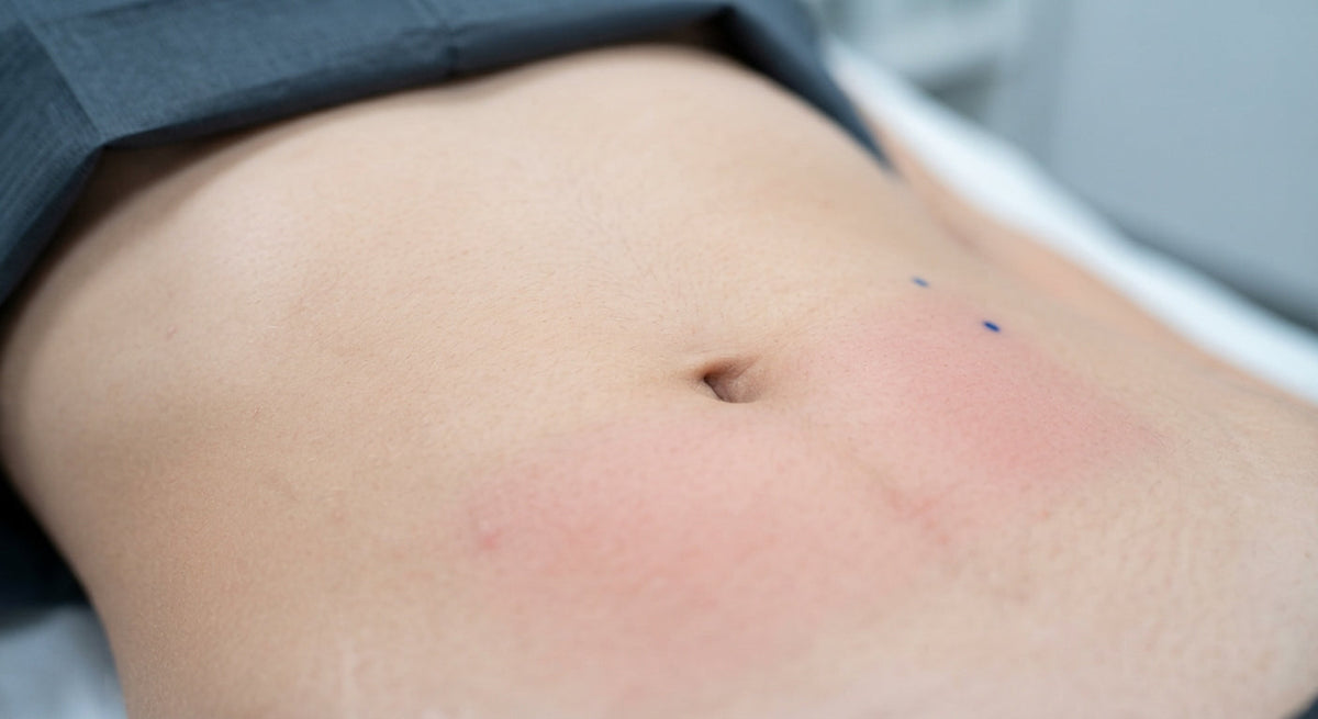 La grasa localizada puede combatirse con medicina estética y hábitos de vida saludables