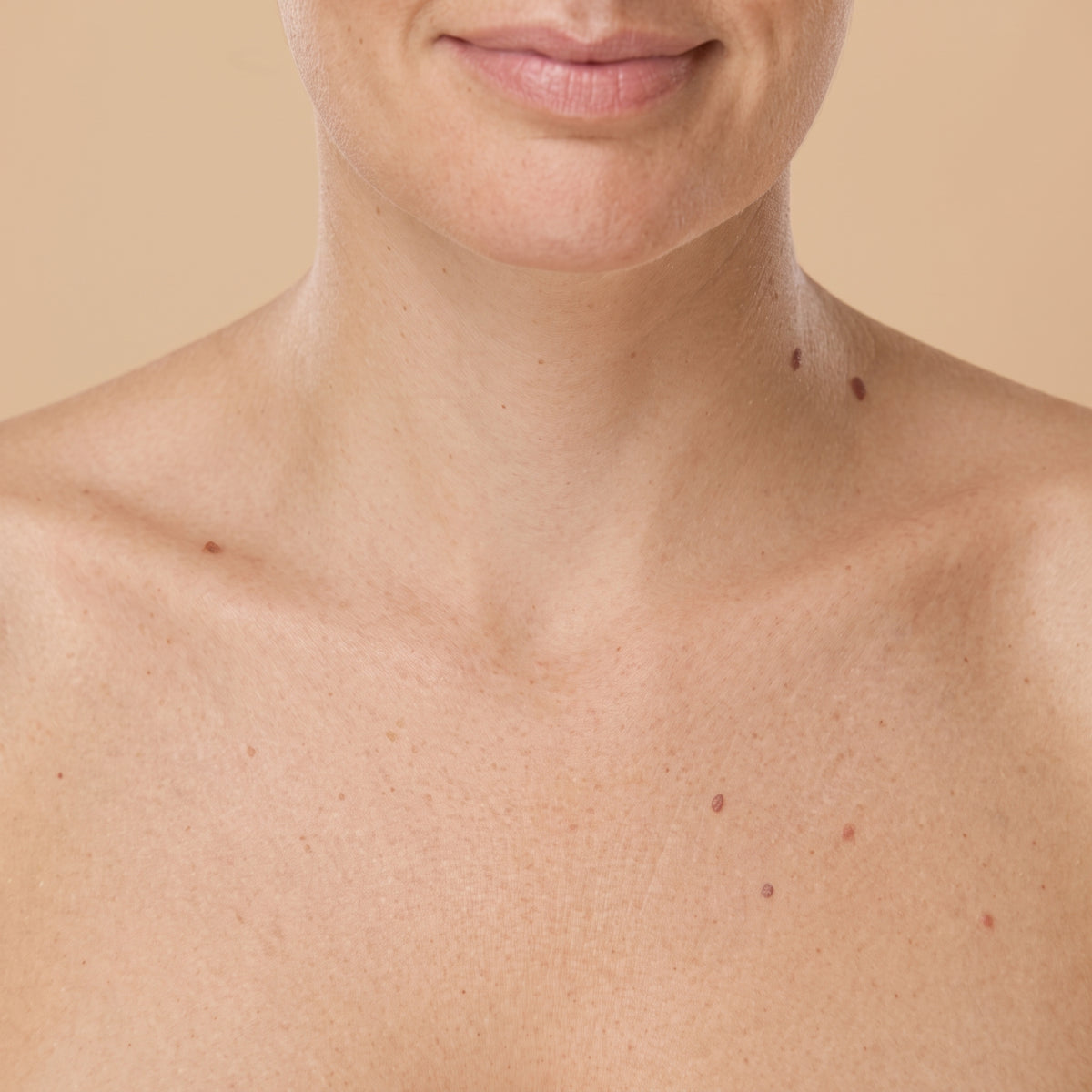 Arrugas en el cuello · Clínica Yolanda Albelda, Santiago