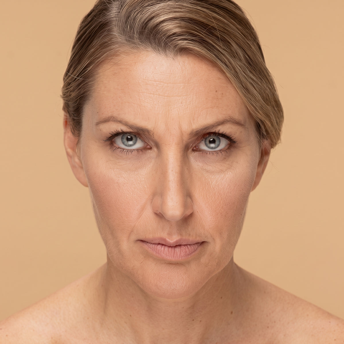 Arrugas entrecejo · Clínica Yolanda Albelda, Santiago