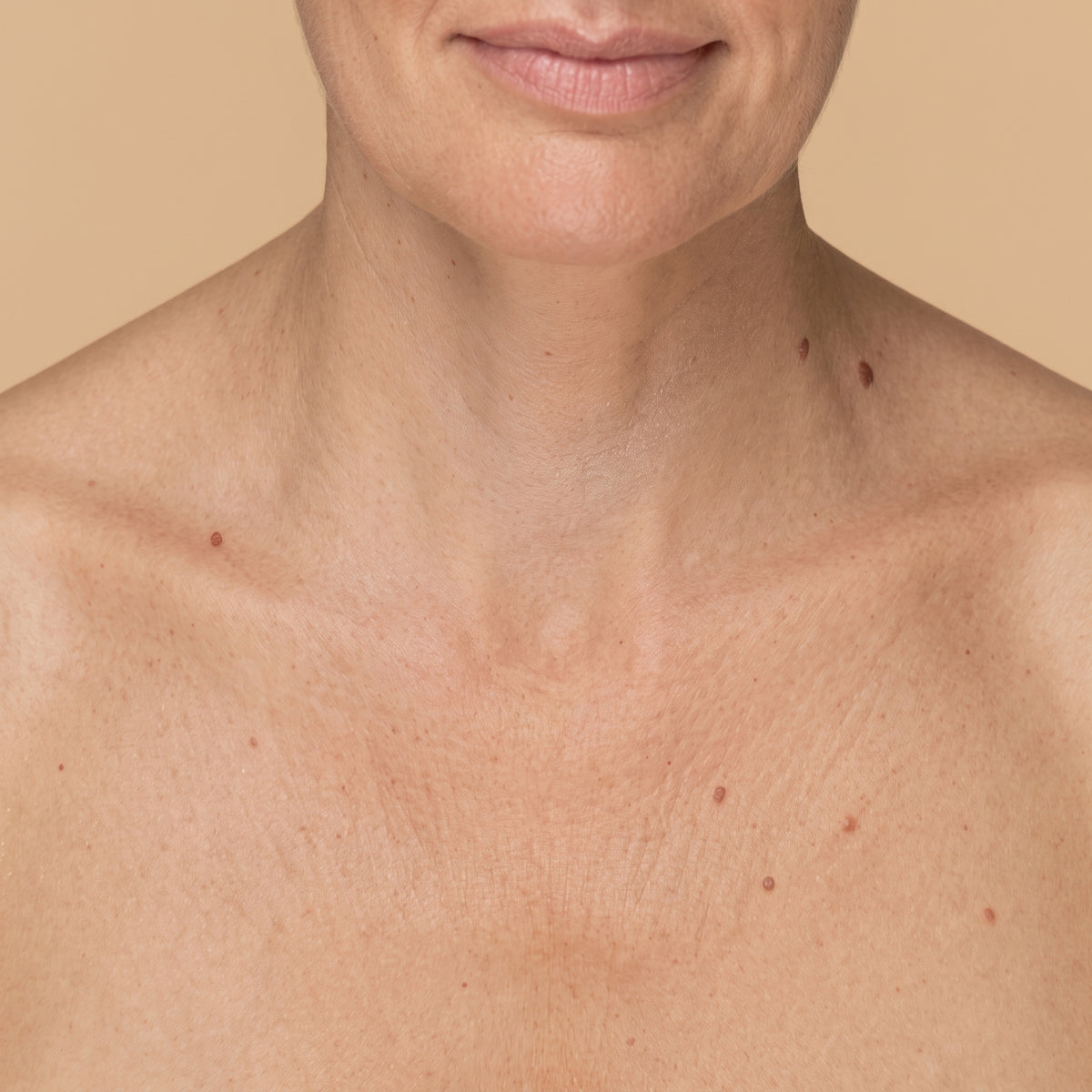Arrugas en el escote · Clínica Yolanda Albelda, Santiago