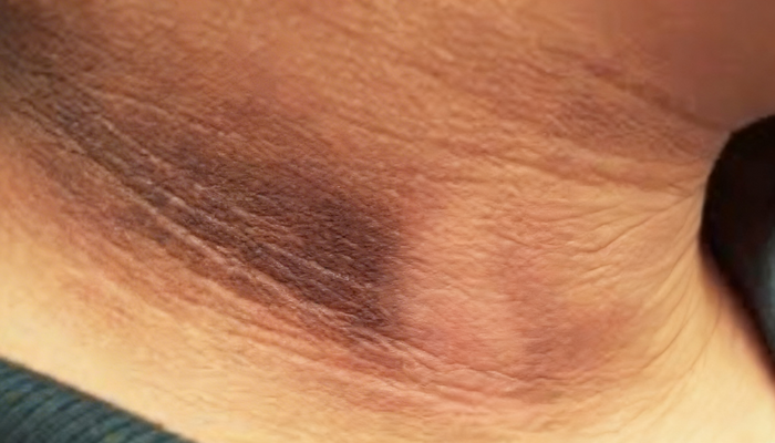 Hiperpigmentación de cuello