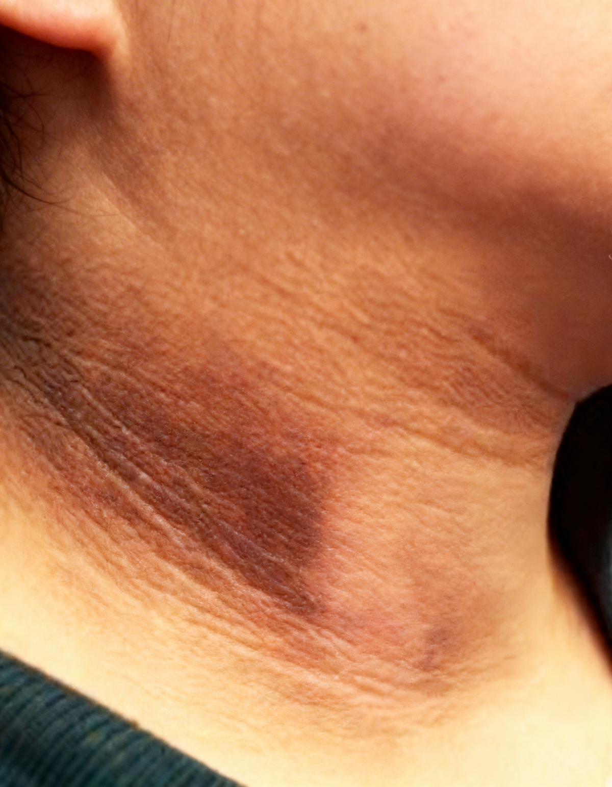 Hiperpigmentación de cuello · Clínica Yolanda Albelda, Santiago