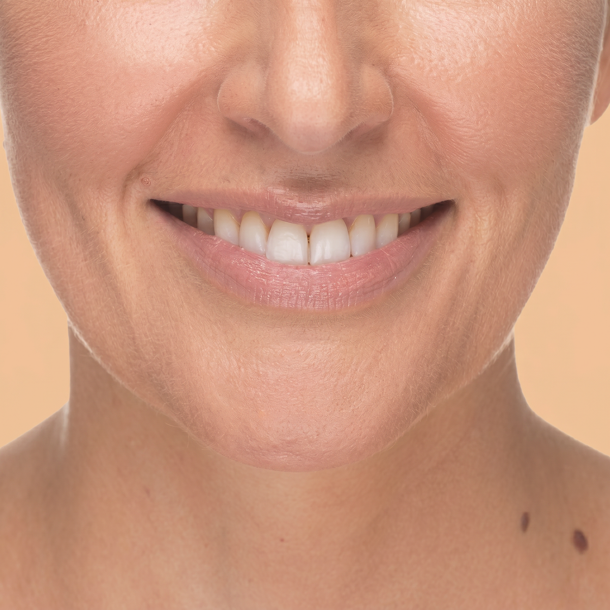 Labios y región peribucal · Clínica Yolanda Albelda, Santiago