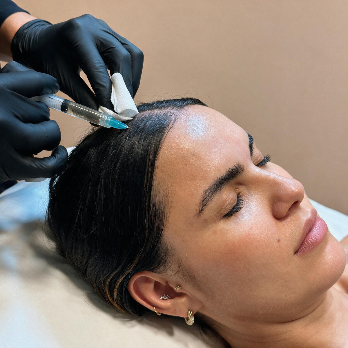 Mesoterapia capilar