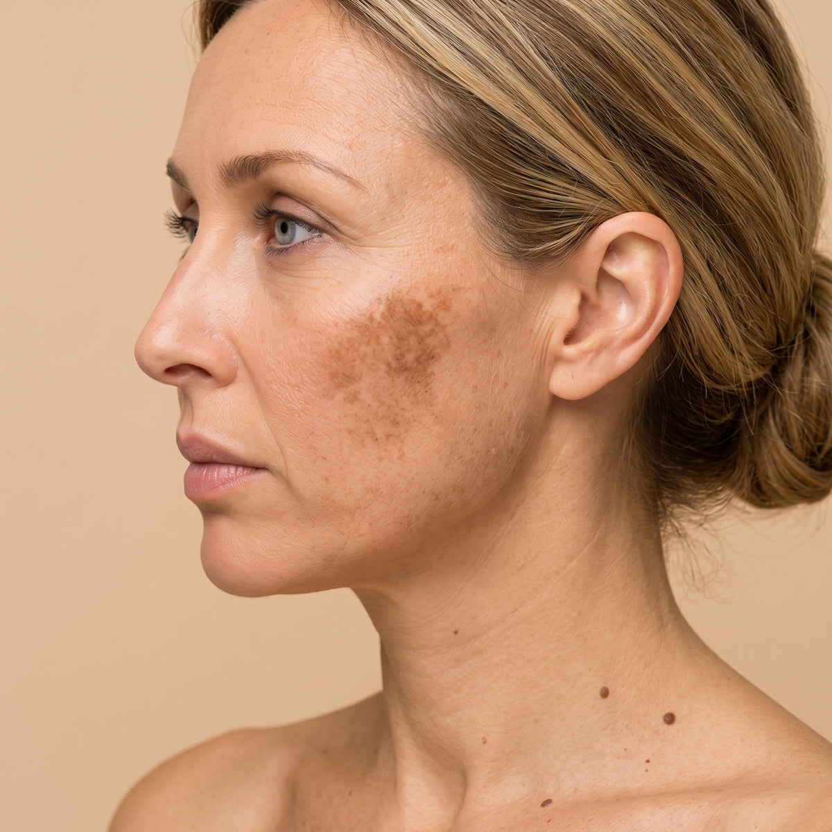 Melasma · Clínica Yolanda Albelda, Santiago