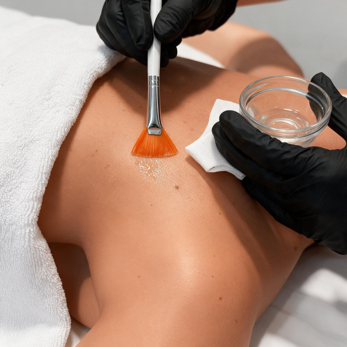 Peeling químico