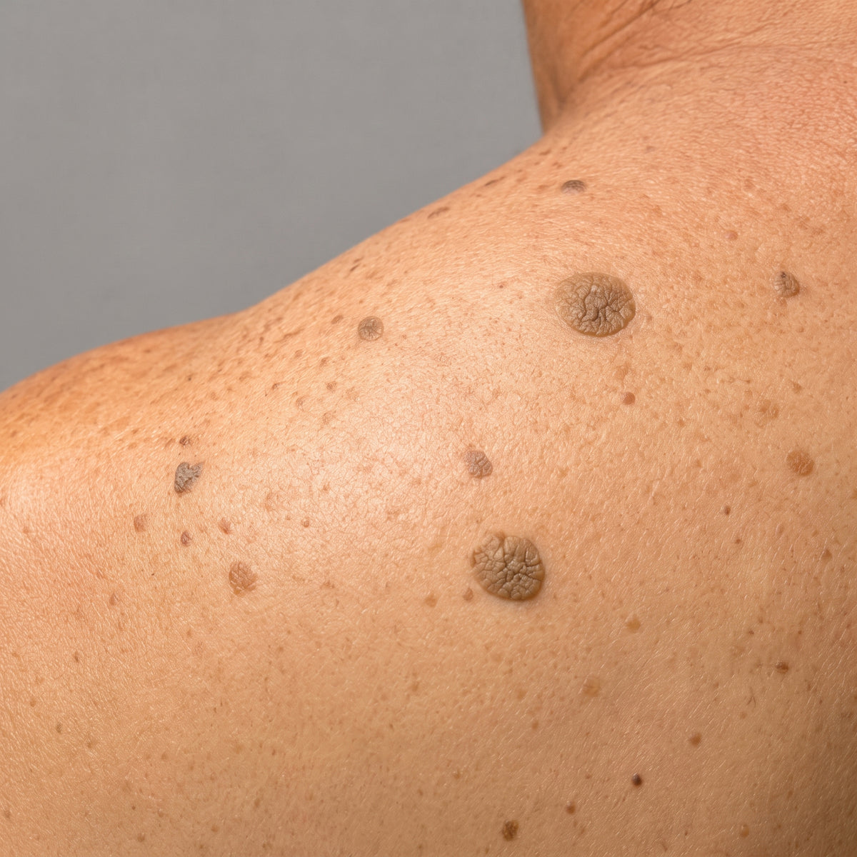 Queratosis seborreica · Clínica Yolanda Albelda, Santiago