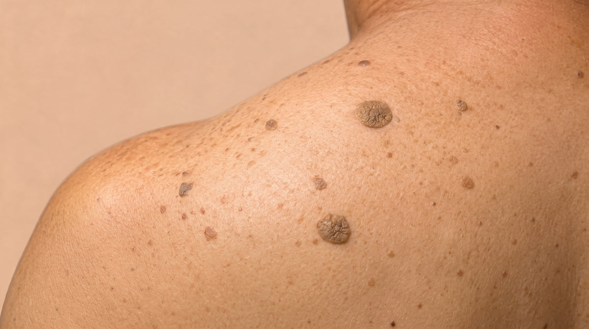 Queratosis seborreica