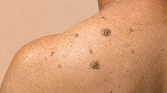 Queratosis seborreica