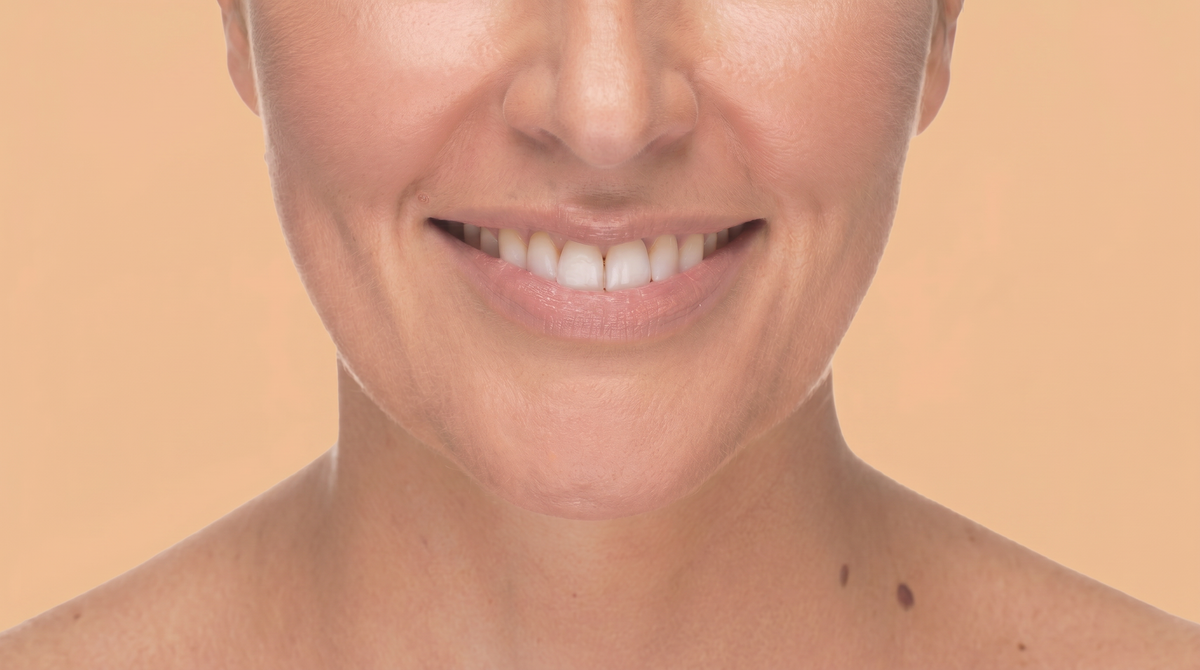 Sonrisa gingival