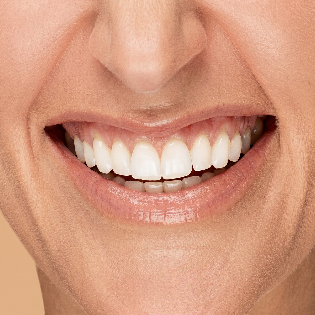 Sonrisa gingival