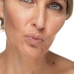Tratamiento de arrugas del labio superior o código barras